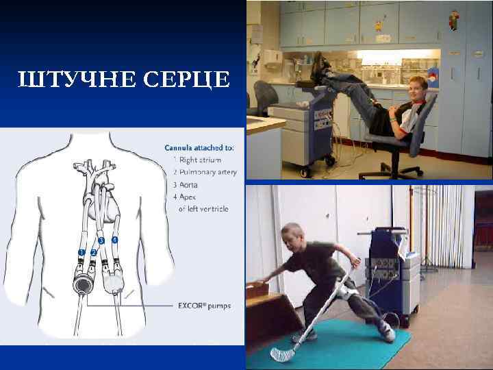 ШТУЧНЕ СЕРЦЕ 