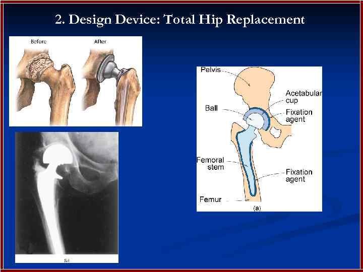 2. Design Device: Total Hip Replacement 