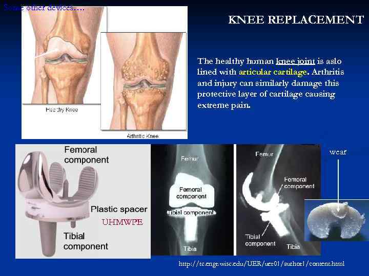 Some other devices…. KNEE REPLACEMENT The healthy human knee joint is aslo lined with