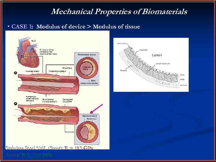 Mechanical Properties of Biomaterials • CASE 1: Modulus of device > Modulus of tissue