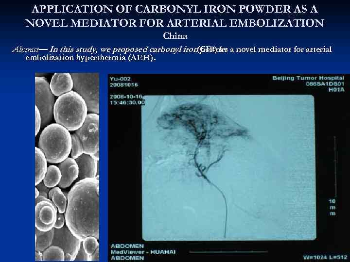 APPLICATION OF CARBONYL IRON POWDER AS A NOVEL MEDIATOR FOR ARTERIAL EMBOLIZATION China Abstract—