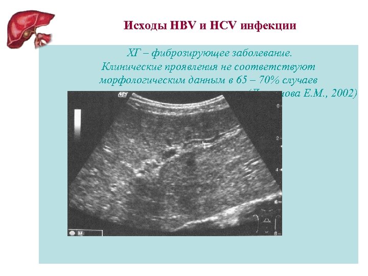 Исходы НВV и НСV инфекции ХГ – фиброзирующее заболевание. Клинические проявления не соответствуют морфологическим