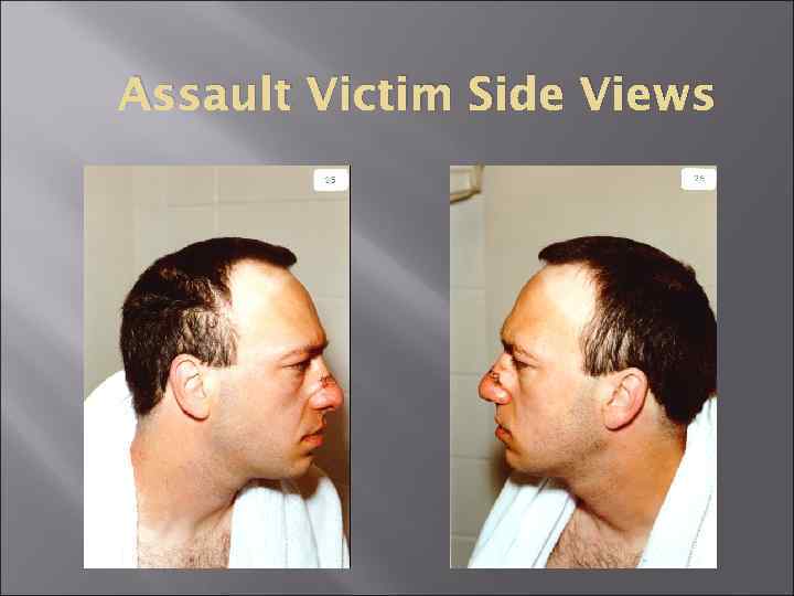 Assault Victim Side Views 