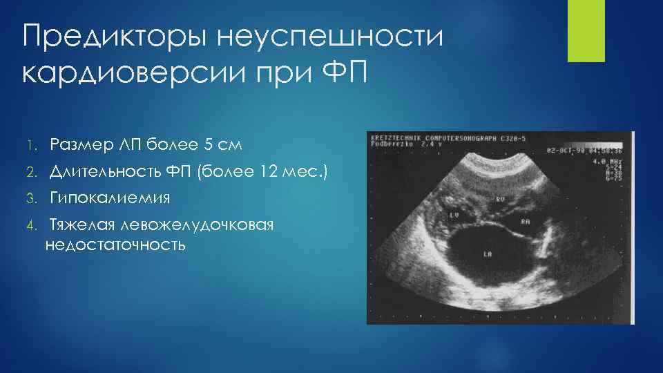 Предикторы неуспешности кардиоверсии при ФП 1. Размер ЛП более 5 см 2. Длительность ФП