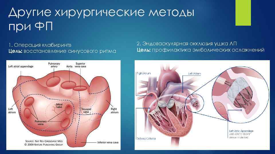 Другие хирургические методы при ФП 1. Операция «лабиринт» Цель: восстановление синусового ритма 2. Эндоваскулярная