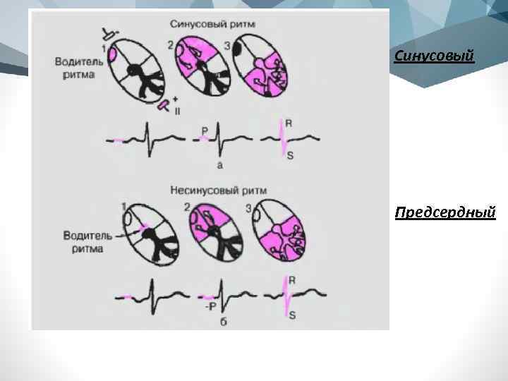 Синусовый Предсердный 