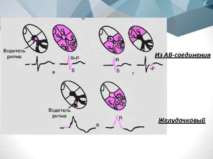 Из АВ-соединения Желудочковый 