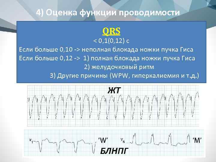 4) Оценка функции проводимости QRS < 0, 1(0, 12) с Если больше 0, 10