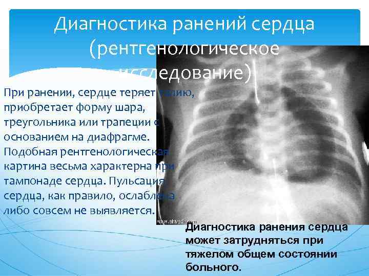 Диагностика ранений сердца (рентгенологическое исследование) При ранении, сердце теряет талию, приобретает форму шара, треугольника