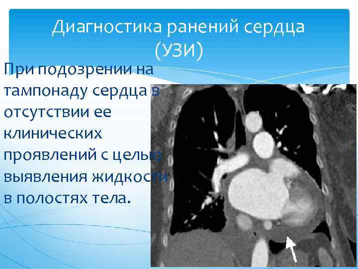 Диагностика ранений сердца (УЗИ) При подозрении на тампонаду сердца в отсутствии ее клинических проявлений