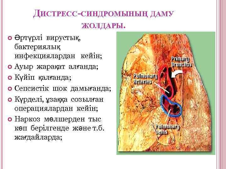 ДИСТРЕСС-СИНДРОМЫНЫҢ ДАМУ ЖОЛДАРЫ. Әртүрлі вирустық, бактериялық инфекциялардан кейін; Ауыр жарақат алғанда; Күйіп қалғанда; Сепсистік
