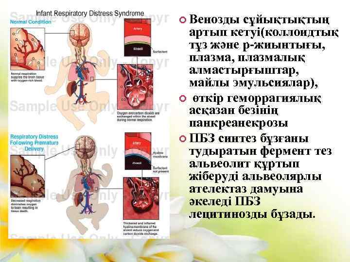  Венозды сұйықтықтың артып кетуі(коллоидтық тұз және р-жиынтығы, плазма, плазмалық алмастырғыштар, майлы эмульсиялар), өткір