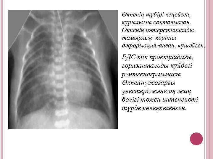 Өкпенің түбірі кеңейген, құрылымы сақталмаған. Өкпенің интерстициалдытамырлық көрінісі деформацияланған, күшейген. РДС. тік проекциядағы, горизантальды