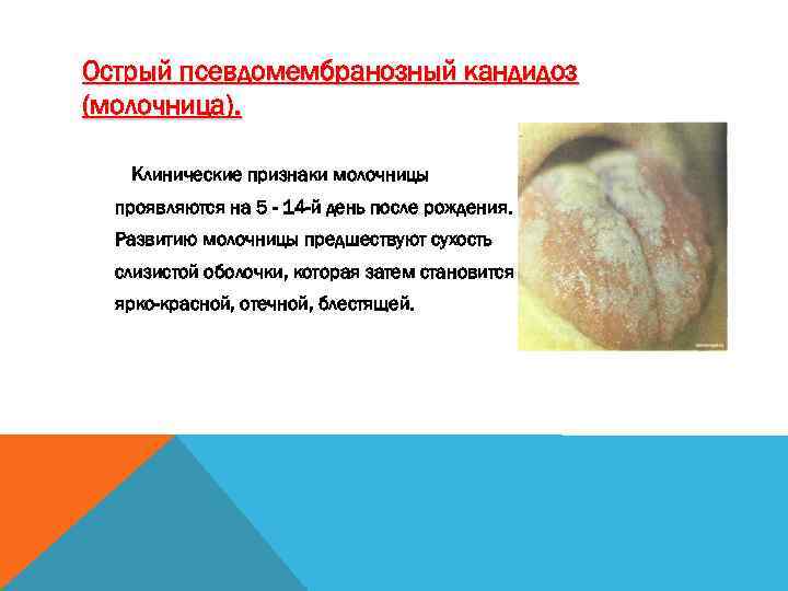 Острый псевдомембранозный кандидоз (молочница). Клинические признаки молочницы проявляются на 5 - 14 -й день