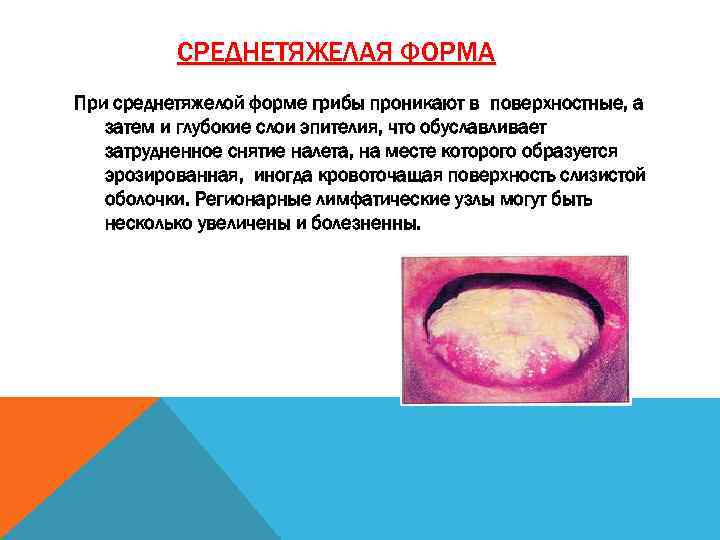 СРЕДНЕТЯЖЕЛАЯ ФОРМА При среднетяжелой форме грибы проникают в поверхностные, а затем и глубокие слои