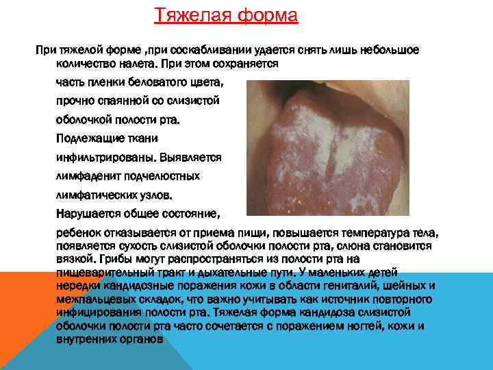 Тяжелая форма При тяжелой форме , при соскабливании удается снять лишь небольшое количество налета.