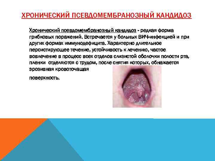ХРОНИЧЕСКИЙ ПСЕВДОМЕМБРАНОЗНЫЙ КАНДИДОЗ Хронический псевдомембранозный кандидоз - редкая форма грибковых поражений. Встречается у больных