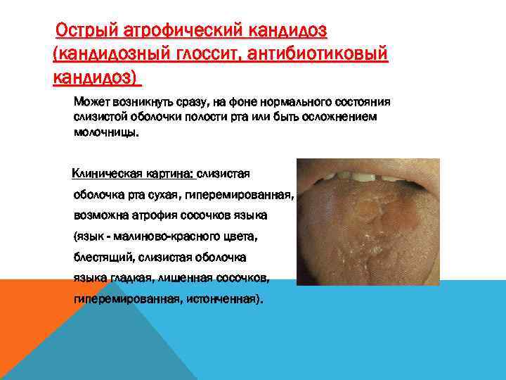 Острый атрофический кандидоз (кандидозный глоссит, антибиотиковый кандидоз) Может возникнуть сразу, на фоне нормального состояния