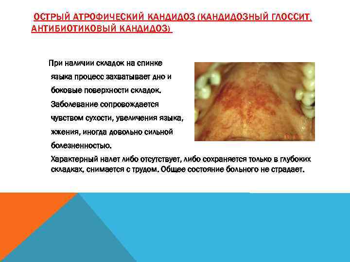 ОСТРЫЙ АТРОФИЧЕСКИЙ КАНДИДОЗ (КАНДИДОЗНЫЙ ГЛОССИТ, АНТИБИОТИКОВЫЙ КАНДИДОЗ) При наличии складок на спинке языка процесс