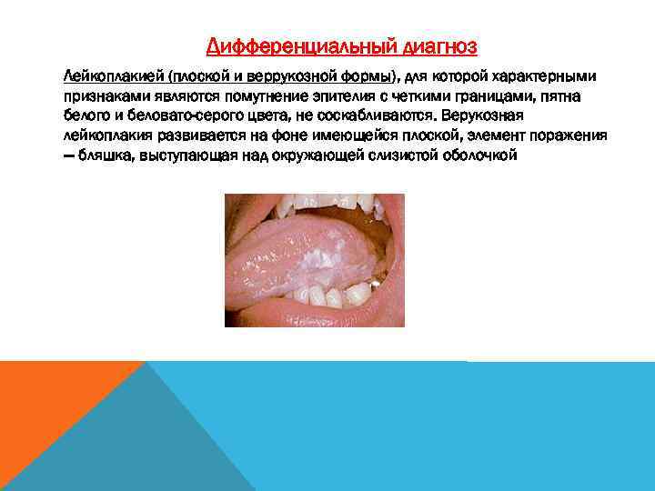 Дифференциальный диагноз Лейкоплакией (плоской и веррукозной формы), для которой характерными признаками являются помутнение эпителия