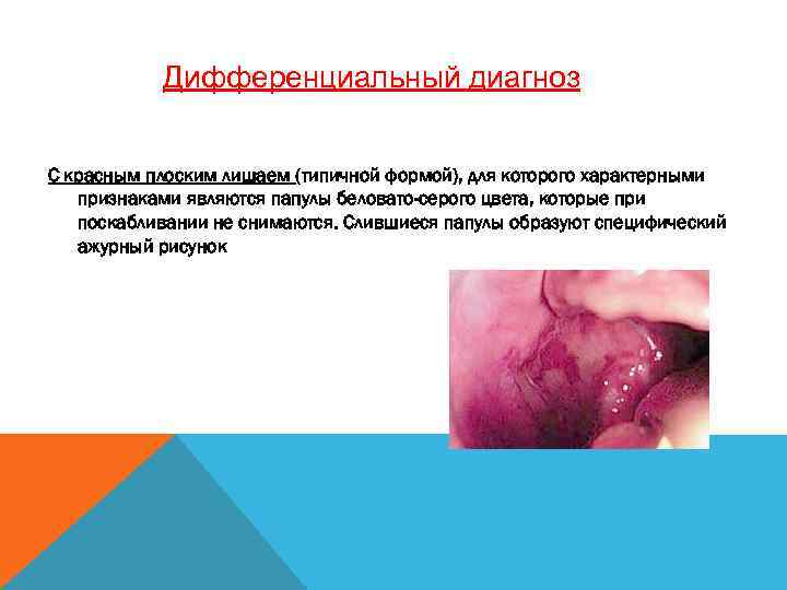 Дифференциальный диагноз С красным плоским лишаем (типичной формой), для которого характерными признаками являются папулы