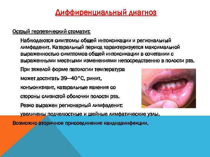 Диффиренциальный диагноз Острый герпетический стоматит: Наблюдаются симптомы общей интоксикации и региональный лимфаденит. Катаральный период