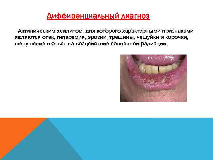 Диффиренциальный диагноз Актиническим хейлитом, для которого характерными признаками являются отек, гиперемия, эрозии, трещины, чешуйки