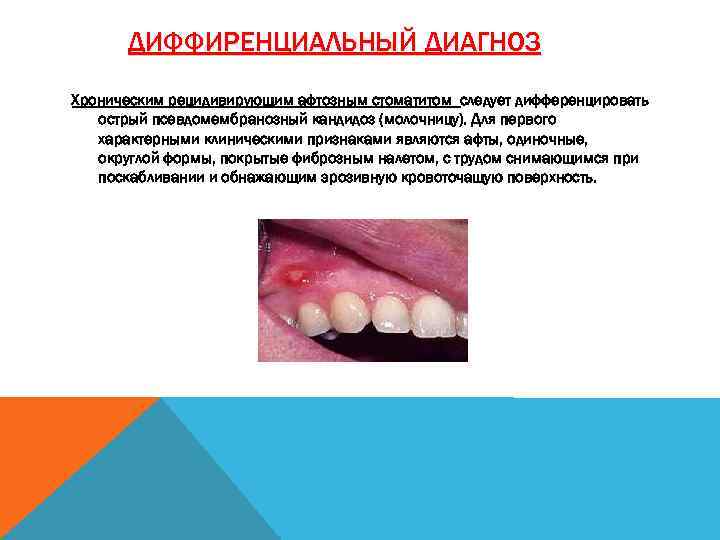 ДИФФИРЕНЦИАЛЬНЫЙ ДИАГНОЗ Xроническим рецидивирующим афтозным стоматитом следует дифференцировать острый псевдомембранозный кандидоз (молочницу). Для первого