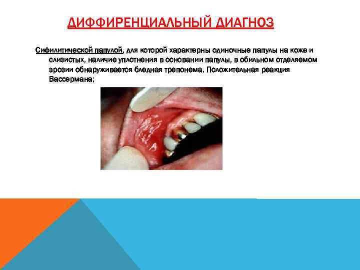 ДИФФИРЕНЦИАЛЬНЫЙ ДИАГНОЗ Сифилитической папулой, для которой характерны одиночные папулы на коже и слизистых, наличие