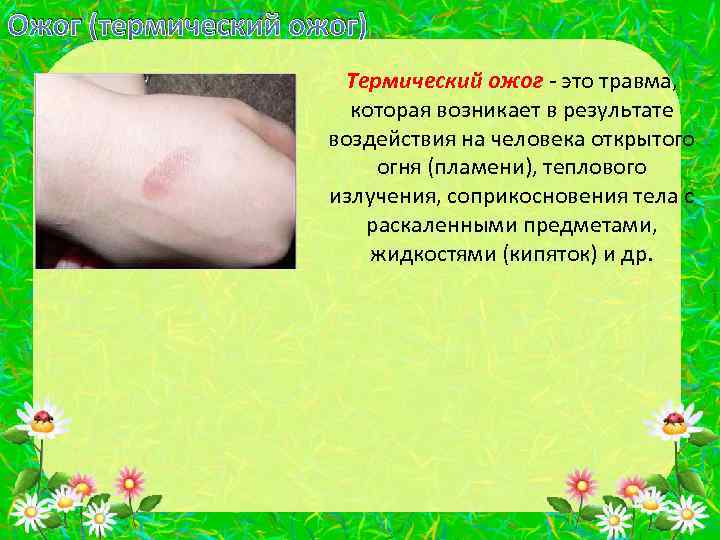 Ожог (термический ожог) Термический ожог - это травма, которая возникает в результате воздействия на