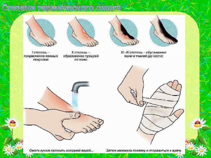 Степени термического ожога 