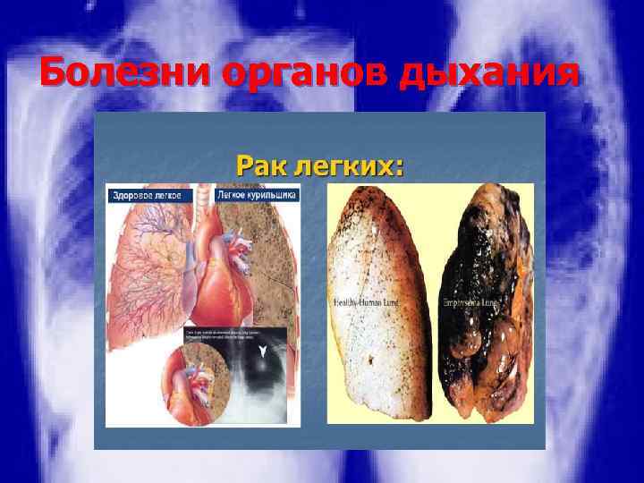 Болезни органов дыхания 