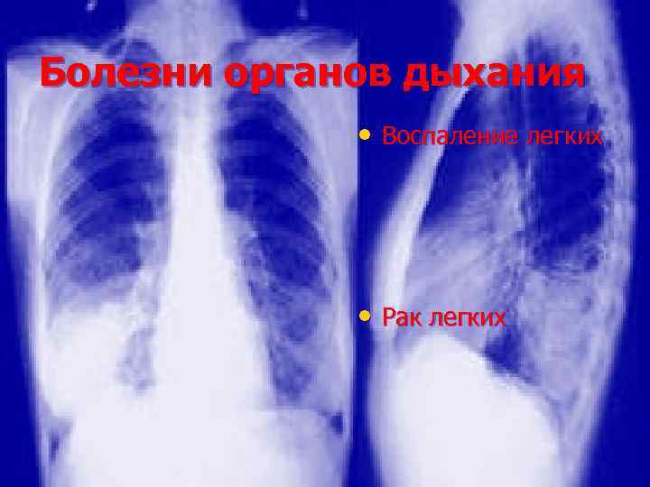 Болезни органов дыхания • Воспаление легких • Рак легких 