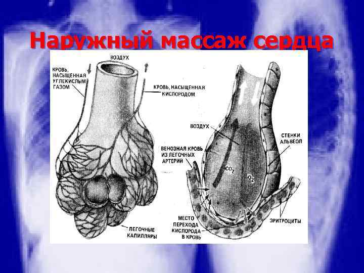 Наружный массаж сердца 
