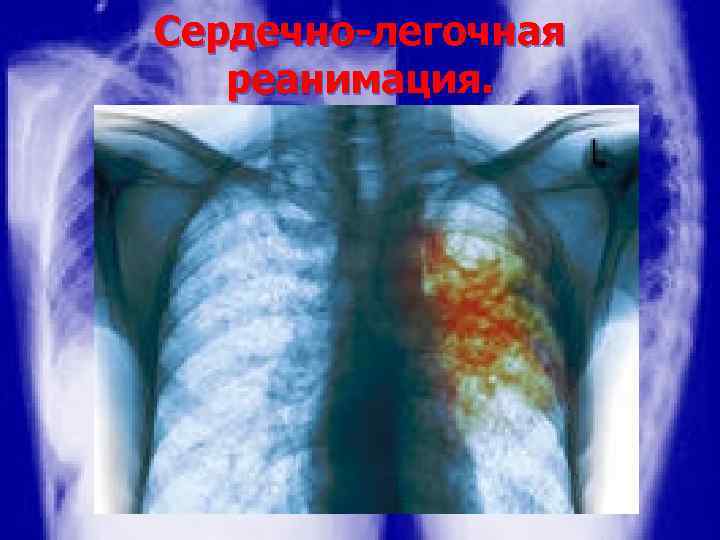 Сердечно-легочная реанимация. Искусственное дыхание 