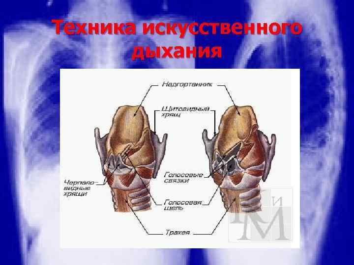 Техника искусственного дыхания 