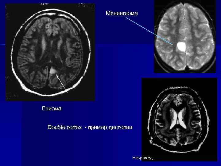 Менингиома Глиома Double cortex - пример дистопии Невромед 