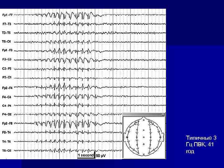 Типичные 3 Гц ПВК, 41 год 