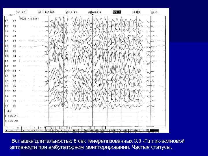  Вспышка длительностью 8 сек генерализованных 3, 5 -Гц пик-волновой активности при амбулаторном мониторировании.