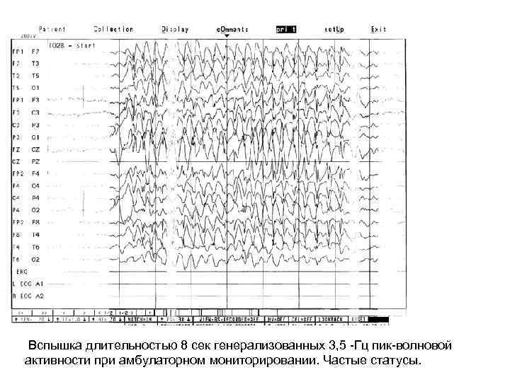  Вспышка длительностью 8 сек генерализованных 3, 5 -Гц пик-волновой активности при амбулаторном мониторировании.