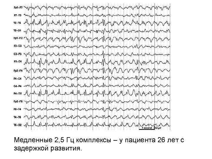 Медленные 2, 5 Гц комплексы – у пациента 26 лет с задержкой развития. 