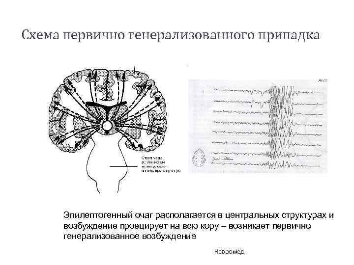 Схема первично генерализованного припадка Эпилептогенный очаг располагается в центральных структурах и возбуждение проецирует на