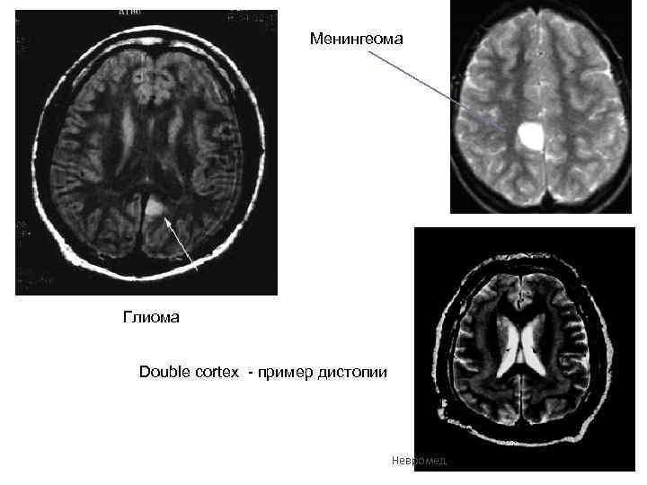 Менингеома Глиома Double cortex - пример дистопии Невромед 