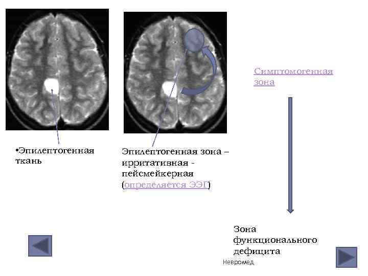 Симптомогенная зона • Эпилептогенная ткань Эпилептогенная зона – ирритативная пейсмейкерная (определяется ЭЭГ) Зона функционального