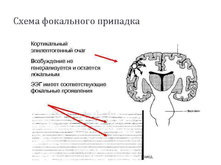 Схема фокального припадка Кортикальный эпилептогенный очаг Возбуждение не генерализуется и остается локальным ЭЭГ имеет