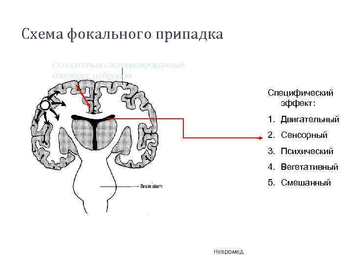 Схема фокального припадка Сознательно активизированный комплекс нейронов Специфический эффект: 1. Двигательный 2. Сенсорный 3.