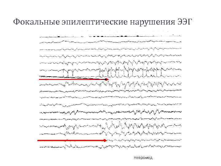 Фокальные эпилептические нарушения ЭЭГ Невромед 