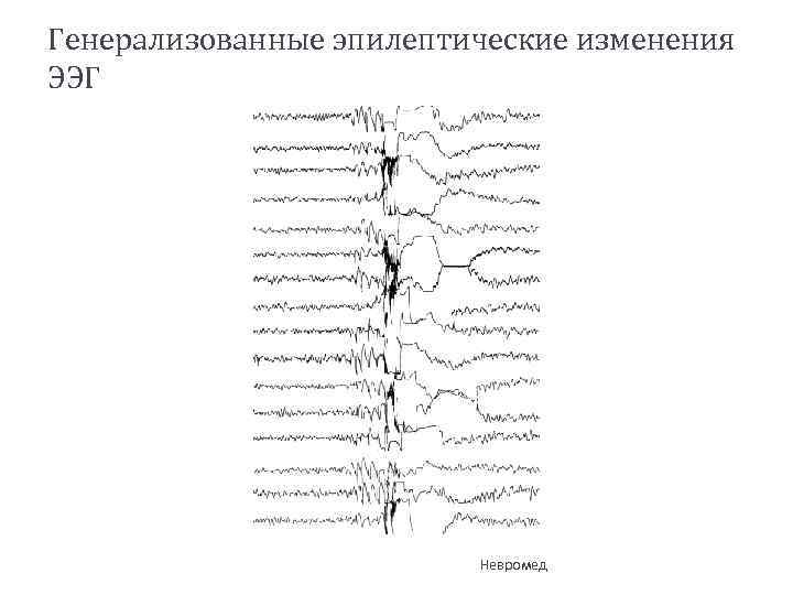 Генерализованные эпилептические изменения ЭЭГ Невромед 