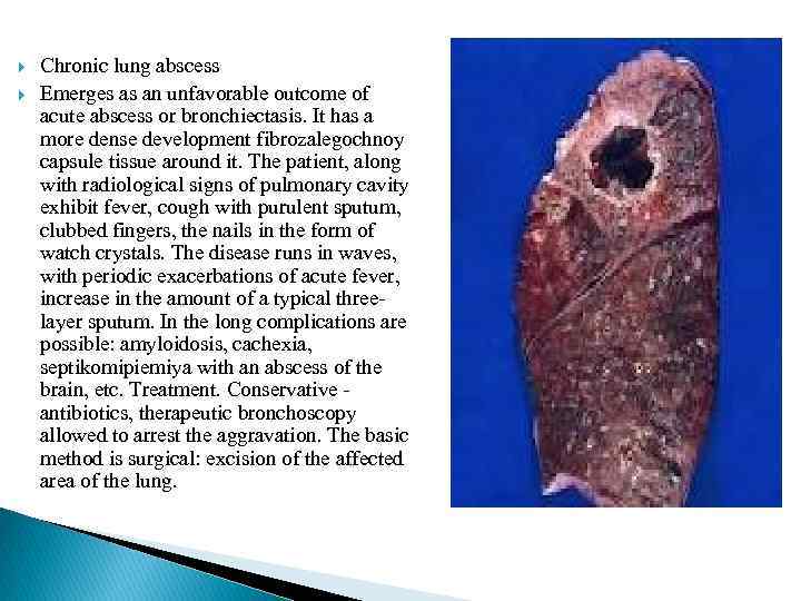  Chronic lung abscess Emerges as an unfavorable outcome of acute abscess or bronchiectasis.