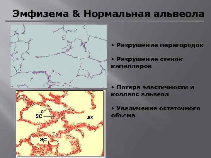 Эмфизема & Нормальная альвеола • Разрушение перегородок • Разрушение стенок капилляров • Потеря эластичности